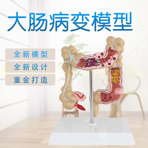 新款 结肠病理模型 结肠病变模型 大肠模型N 肠解剖模型 肠子模型