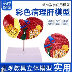彩色肝脏模型常见临床病理特征医生用医患M沟通硬化脂肪炎肝胆内