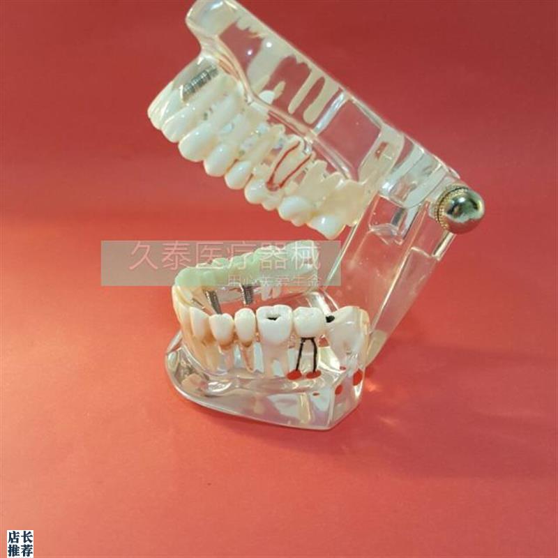 牙齿模型a成人透明病理种植修复模型牙科模型(包邮)口腔模型