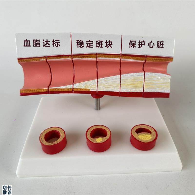 血管/堵塞动支脉粥样/硬化心y血管动脉/硬化模型血管病理模型血栓