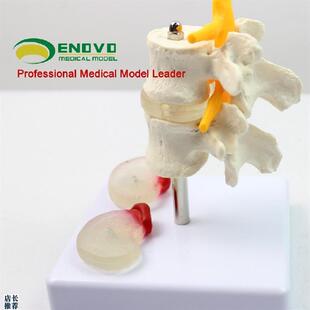 ENOVO颐e诺人体腰椎椎间盘突出模型骨骼脊柱脊椎骨科模型骨科科中