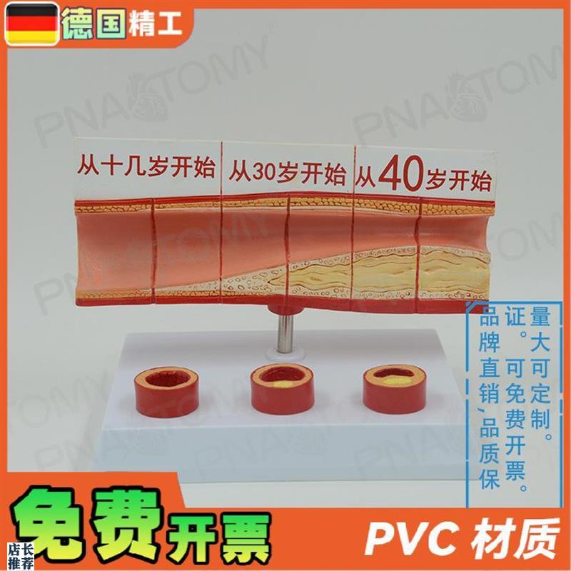 德国】人体动脉血l管堵塞模型心脑血管血栓/硬化模型教学心脑血管