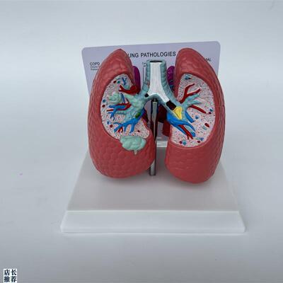 人体肺部病理解剖展示模型医w用教学医患讲解肺泡解剖气管咽炎病