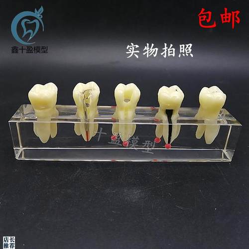口腔教学b模具水晶根管治疗模型可拆修复牙冠龋齿蛀牙病理M4012