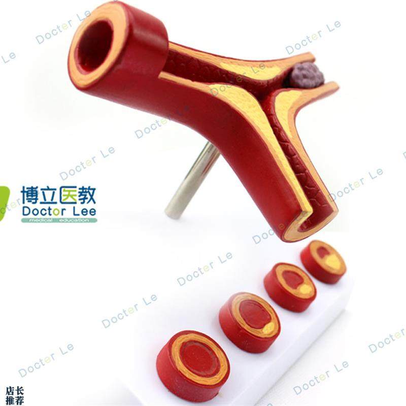人体支脉粥样化和血全形v成模型血管模型人体血管解剖模型