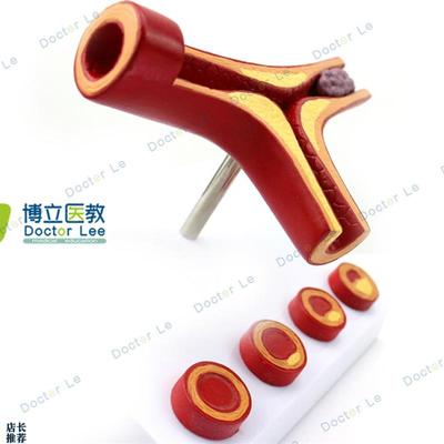 人体支脉粥样化和血全形v成模型血管模型人体血管解剖模型