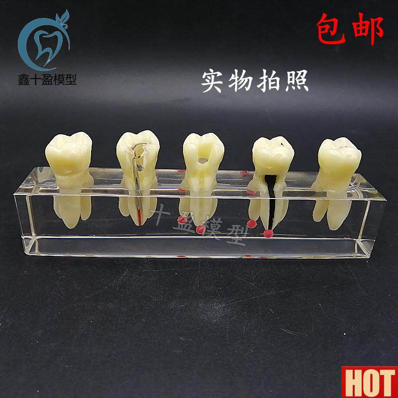 腔教学模具n 水晶根管治疗模型 可拆修复牙冠 龋齿蛀牙病理M4012