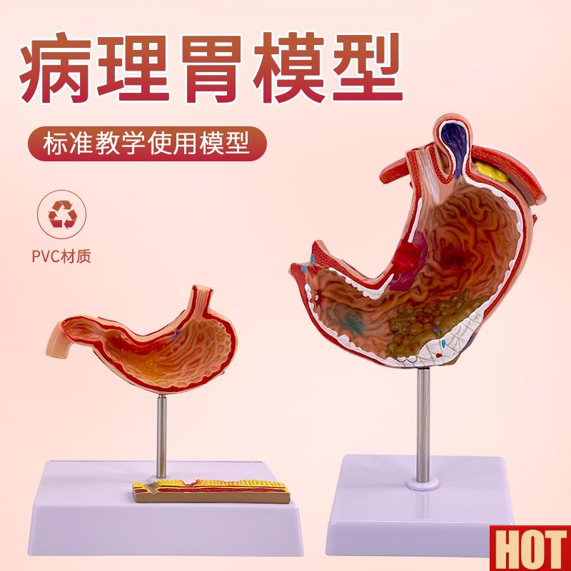 理胃模型 人体胃的穿孔 病态G胃模型 消化科 胃冠状剖面解剖放大