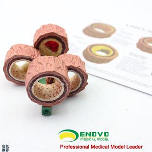 颐诺正品动脉粥样硬化模型血栓病变模O型心血管模型内科学