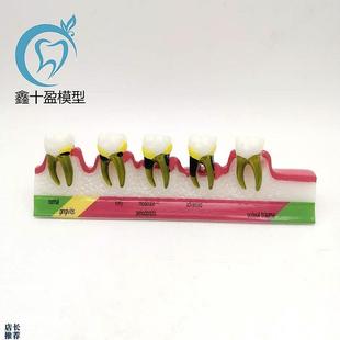 牙科口腔教学演示模型龋齿牙周根管医患沟通牙U周分类模型M8