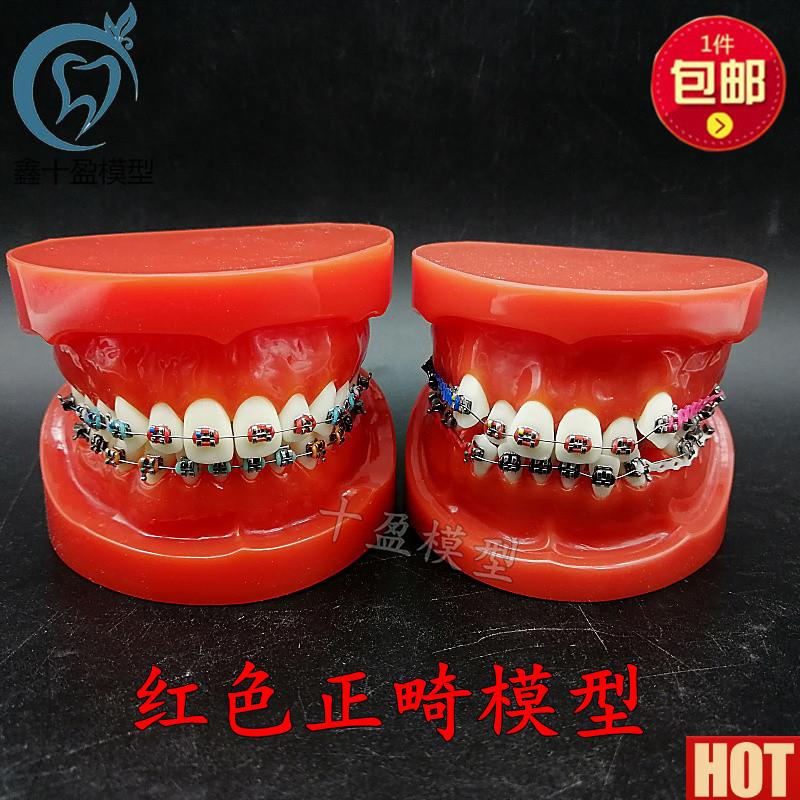 腔牙列整齐正畸模型Y红牙列不齐错颌缺失牙齿仿真牵引皮链支抗钉