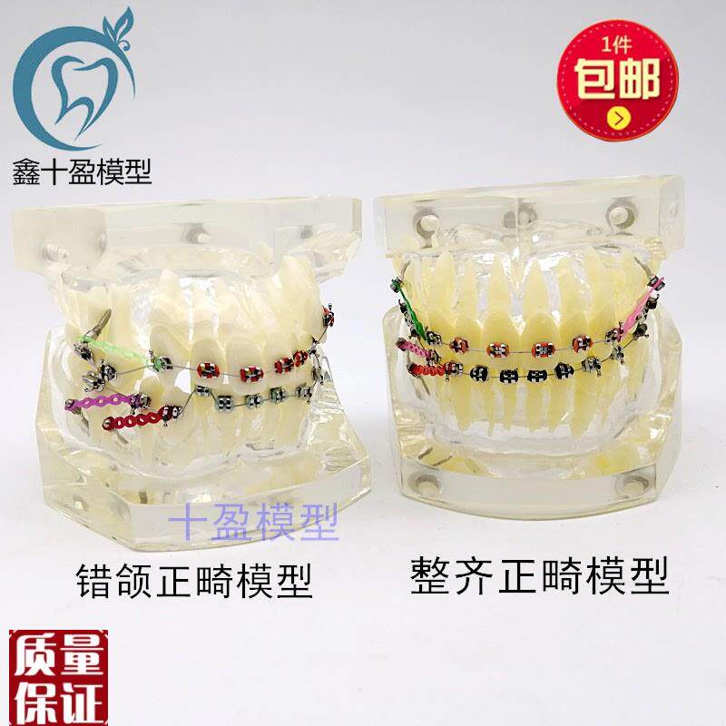 牙科正畸模型透明错颌矫正展示模型结扎丝托槽正W畸带支抗钉牙