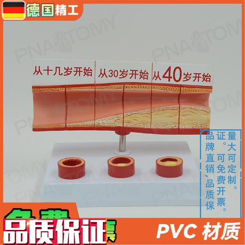德国】人体动脉血管堵塞模型心脑血管H血栓/硬化模型教学心脑血管