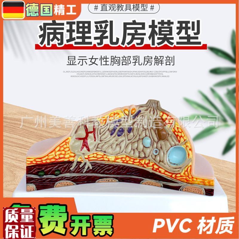 病理乳房模型乳房病变模型乳房C解剖模型乳房常见疾病乳房模