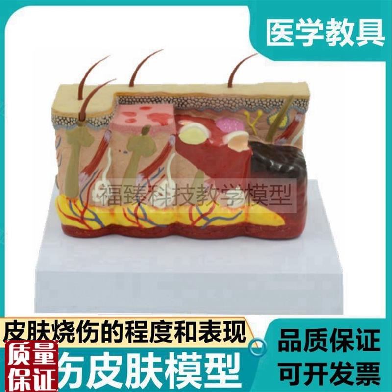 皮肤烧伤程度模型临床p表现皮下组人体皮肤结构毛发毛囊微整形医