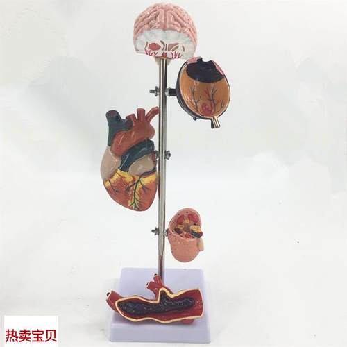 高/血压模型5部n分血压病理变脑眼心脏肾脏血管内脏模型