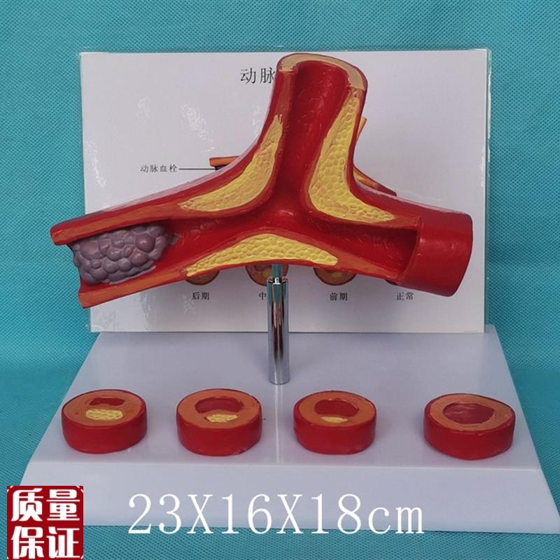 人体血管解剖模型病变血z管比较模型医用教学动脉粥