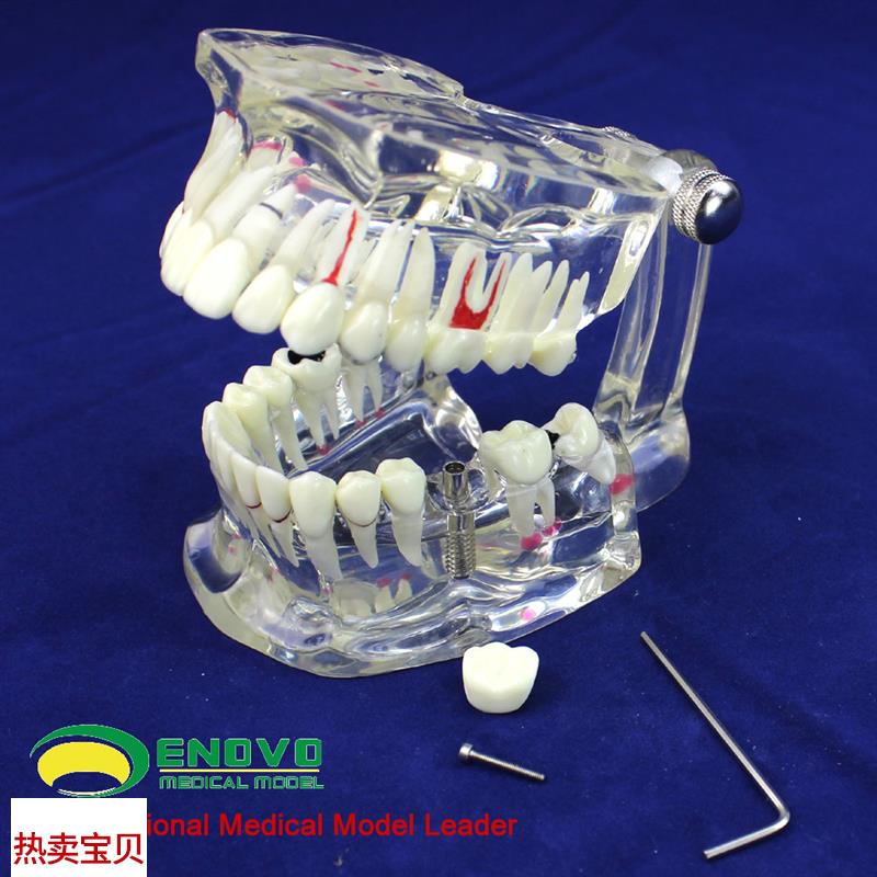 ENOVO颐诺牙j齿模型口腔牙齿科种植模型口腔病理模型种植体牙冠义
