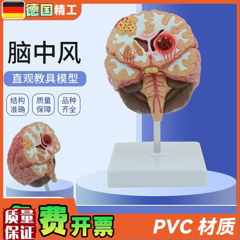 德国】人体脑解剖模型脑出血动脉大脑动静脉畸形Y脑病理大脑教