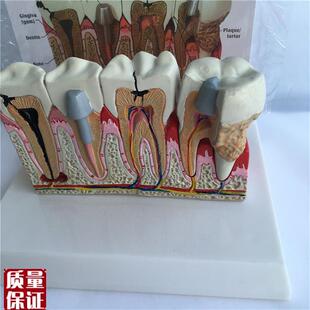 蛀牙虫牙牙齿牙病模型烤瓷冠牙牙龈炎牙周炎牙垢镶牙Y教仪厂家直