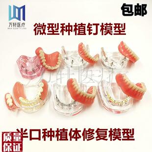 牙科口腔教学模型种植修s复对比模型微型种植钉2颗4颗钉种植球帽