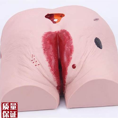 老年人褥疮(压疮)护理模型褥疮N压疮护理模型褥疮模