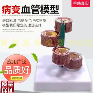 硬化支脉粥样血管模型心血管动脉解剖模型人R体病态血管模型血