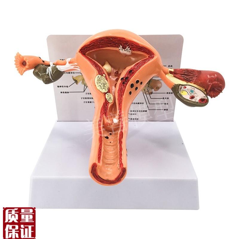 子宫卵巢病理病变模型生殖科医D药礼品模型女性子宫阴道模