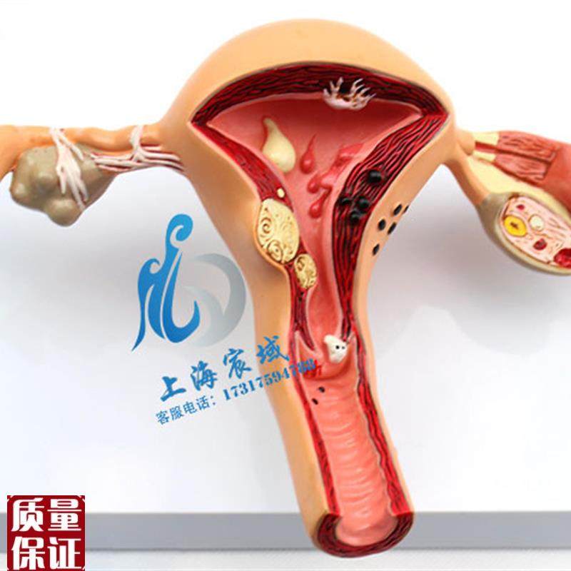 子宫卵巢病理病变模型生殖科D女性内外生殖器官模具教学病