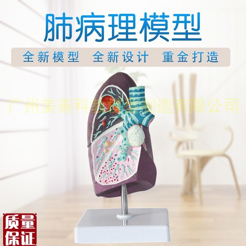 人体肺模型病理肺解剖s模型呼吸系统人体脏器模型病变肺模