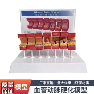 7节动脉粥样硬化模型血管血栓栓塞演G示模型人体血管模型医用教