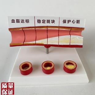 血管/堵塞动支脉粥n样/硬化心血管动脉/硬化模型血管病理模型血