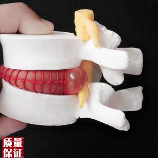 人体腰椎间盘膨出演示模型腰椎模型人体T脊柱模型脊椎模