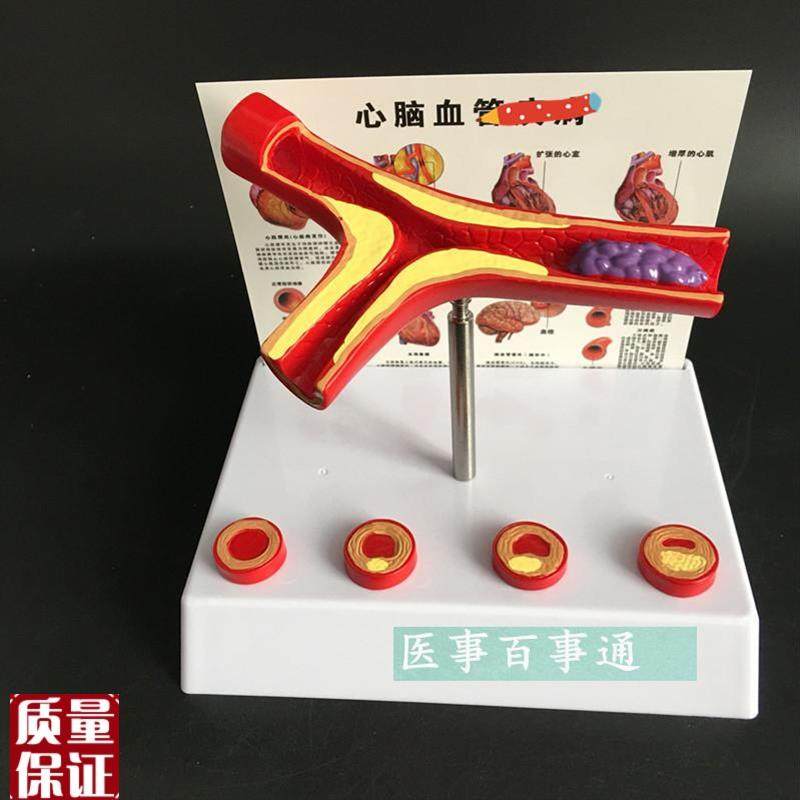 动脉模型心病血管解剖面模型血管模型N血管解剖模型教学包