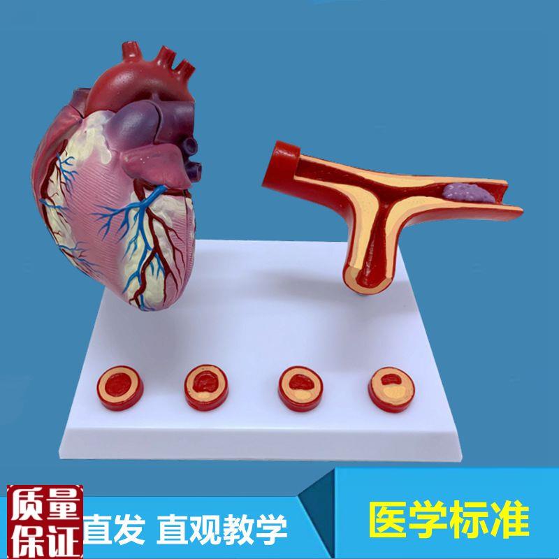 心血管病理模型冠m状动脉粥样硬化狭窄内膜斑块脱落临床医患医药