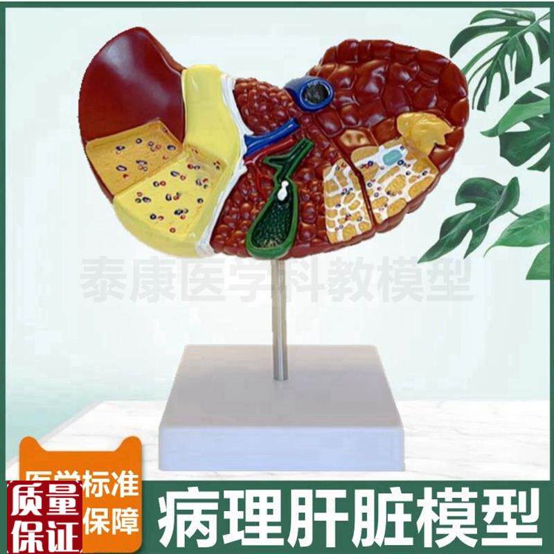 病理肝脏模型临床常见肝胆胰外z科医生用胰腺脾脏十二指肠消化系