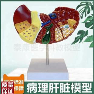 病理肝脏模型临床常见肝胆胰外z科医生用胰腺脾脏十二指肠消化系