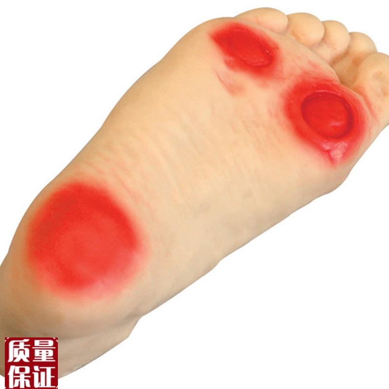 正品高级糖尿病足o护理模型足部病变护理模型畸形脚模