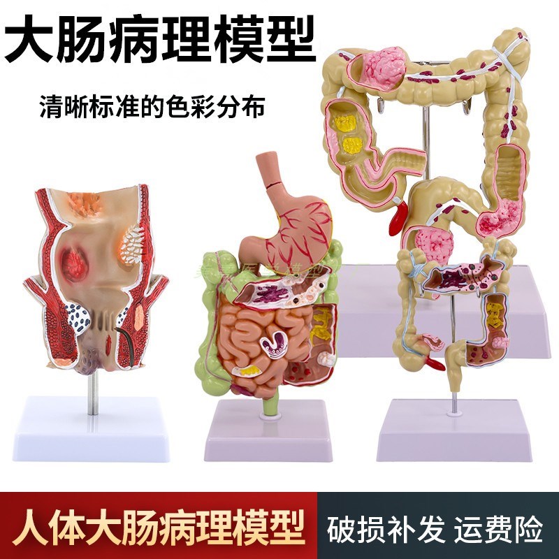 大肠病理模型 肠胃模型 大肠病变模型 肠O道疾病 结肠病变模型