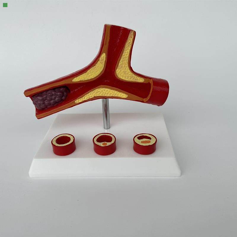 心脑血管堵塞模型关节血栓血液浓度脂肪病理粥样硬化人体解剖教具