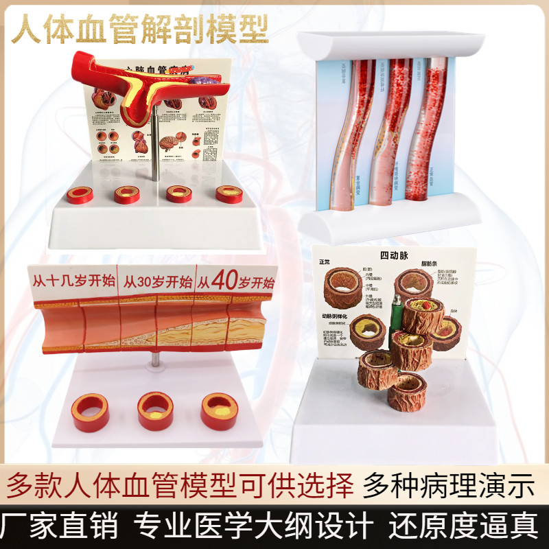 血管堵塞动支脉粥样硬化心血管动脉硬化模型O血管病理动态血栓模