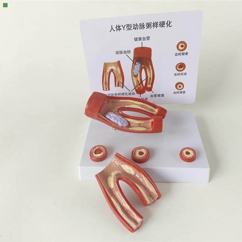人体心脑血管动脉粥样硬化堵塞模型血栓血液脂肪病理解剖医学教具
