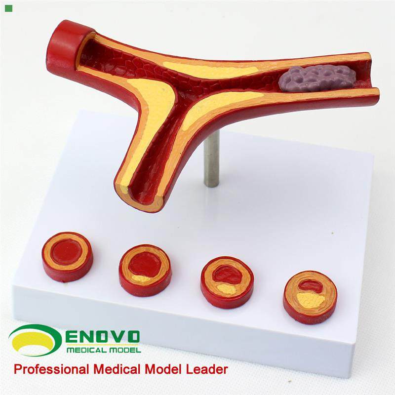 颐诺正品冠状动脉性心血管动脉硬化模型老年心脏模型血栓形成