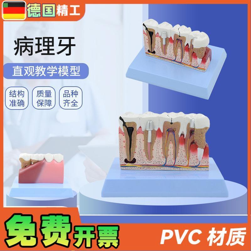 德国牙齿牙科病理学医学教学沟通模型解剖放大病理演示牙科模型病