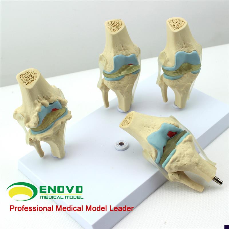 颐诺正品人e体病理膝关节模型血友病退行性膝关节病发炎膝关节模