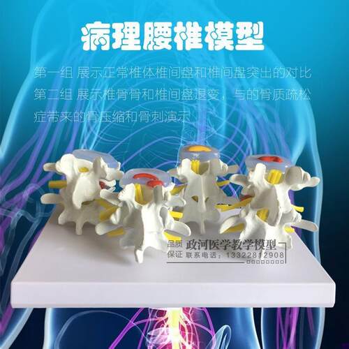 教学仿真病理脊椎模型四分u型脊椎正常与bing变腰椎组合模型脊椎