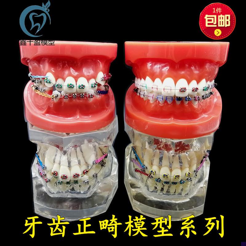 牙科正畸模型 透明错颌矫正展示模型 结扎丝托槽R正畸带支抗钉牙