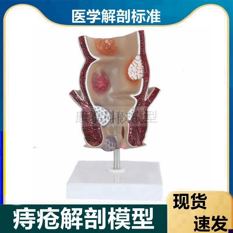 人体直肠模型 肠道保健肛肠科大肠消化系统肛周痔V疮结肠肉突出肿