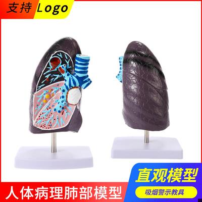 人体肺模型 病理肺解剖模型 吸烟肺 呼吸系统N 病态肺 病变肺模型