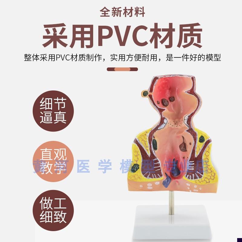 人体直肠模型 i结肠病理直肠 痔疮 直肠常见病模型 直肠和肛管模